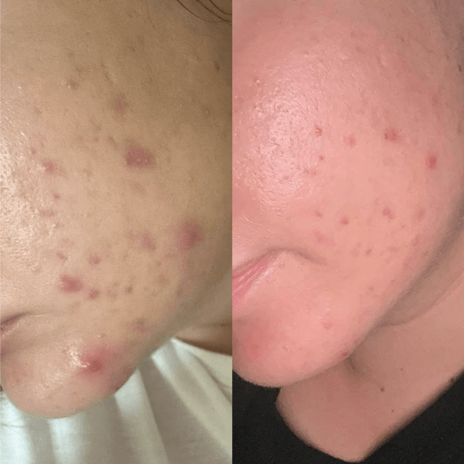 risultati skincare su acne prima e dopo