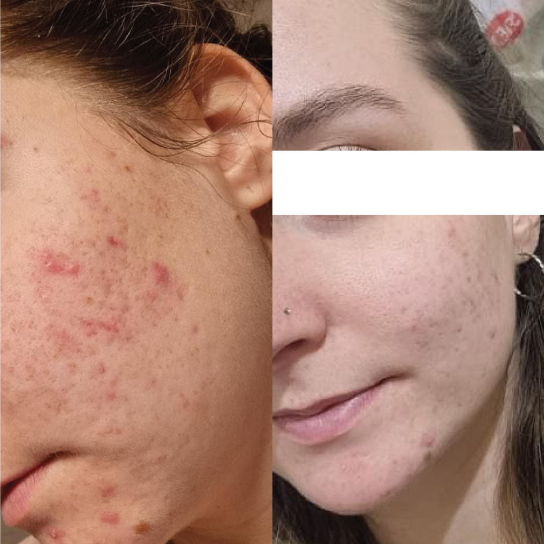risultati skincare pelle acneica prima e dopo