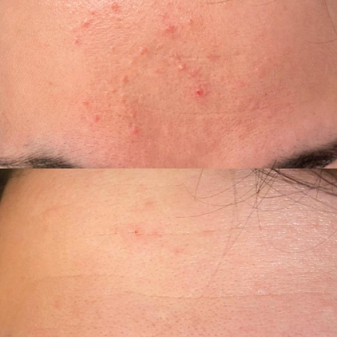 acne prima e dopo utilizzo kubla