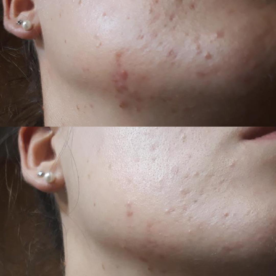 acne sul viso prima e dopo kubla