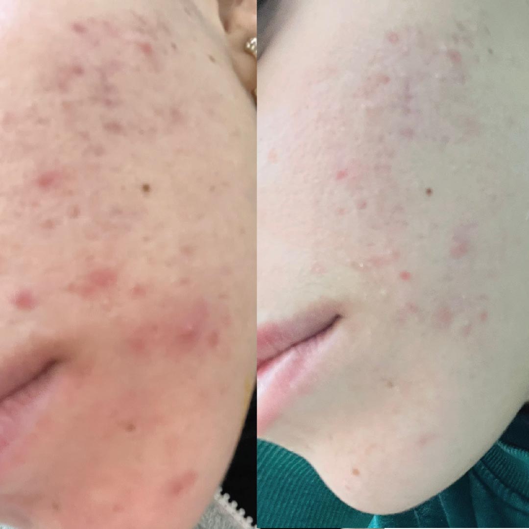 pelle acneica prima e dopo skincare kubla