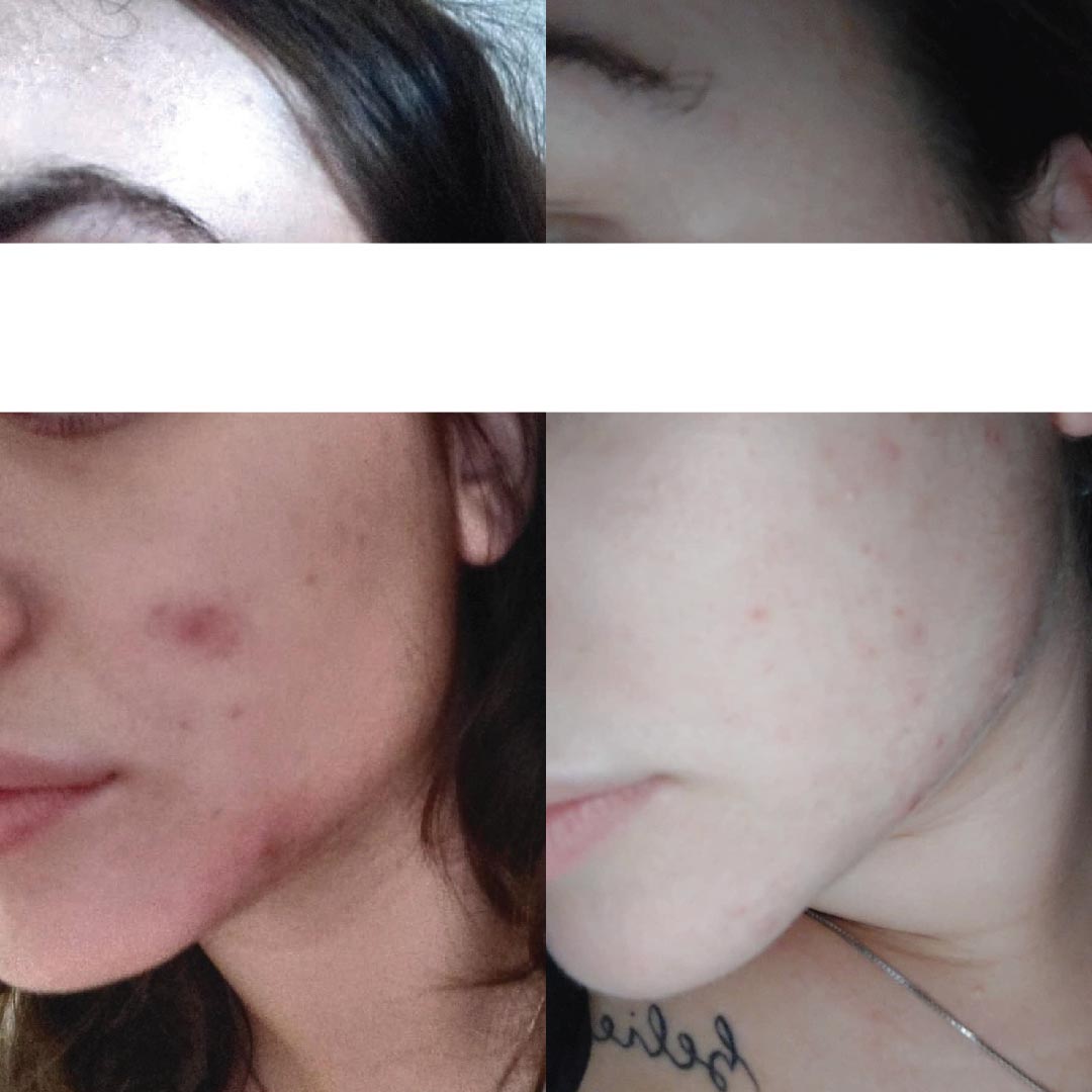 prima e dopo skincare routine kubla
