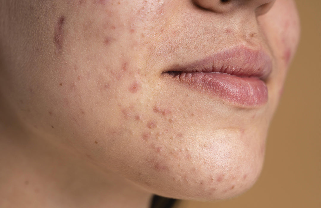 acne autunnale