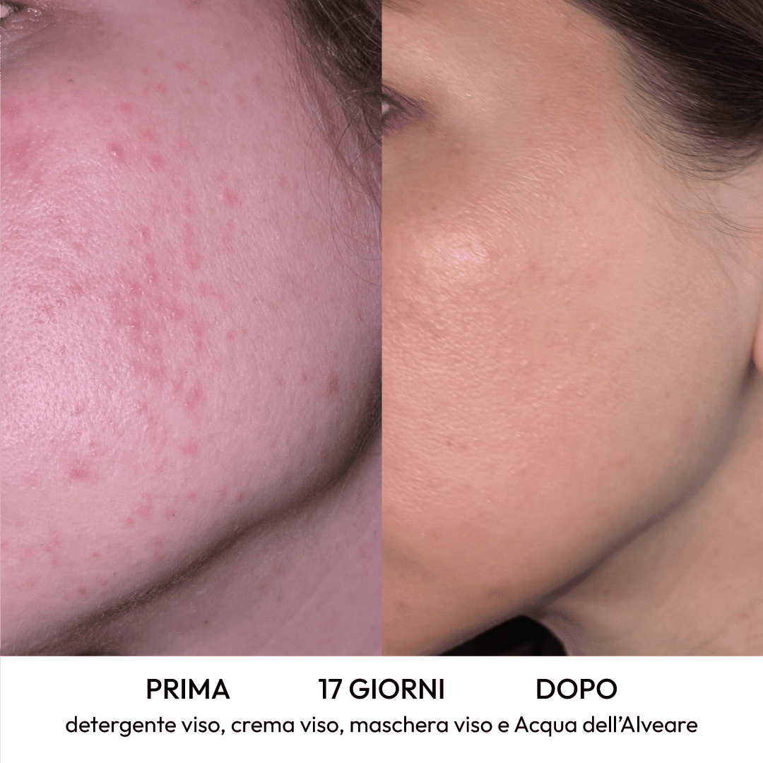Kubla - Maschera viso per brufoli, rossori e punti neri
