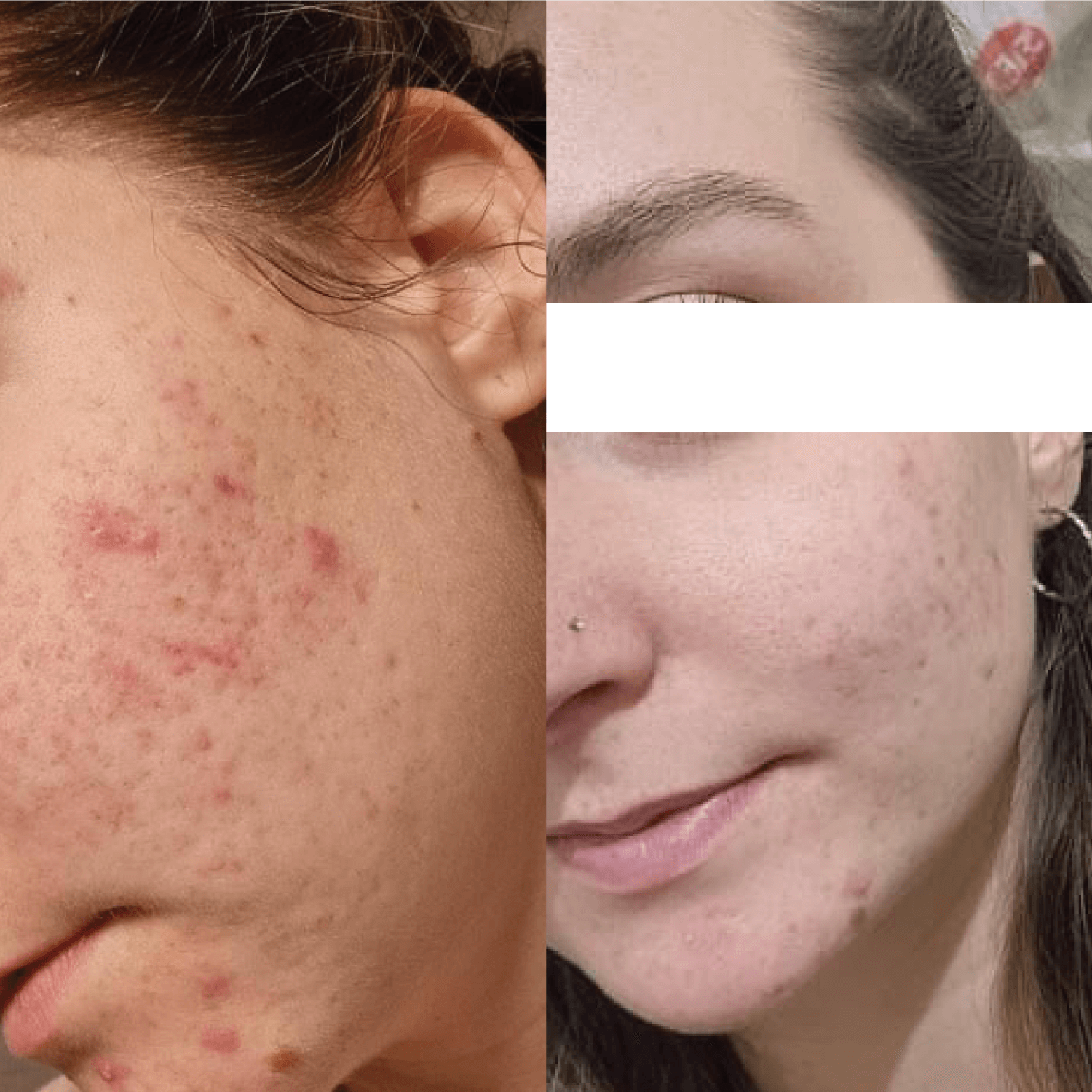 prima e dopo rossori acne
