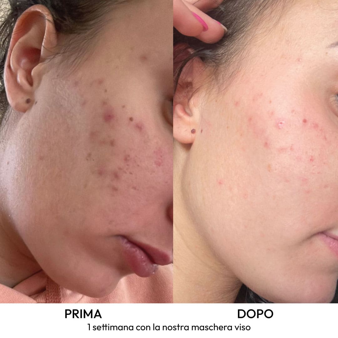 Kit Essenziale per acne, brufoli e macchie