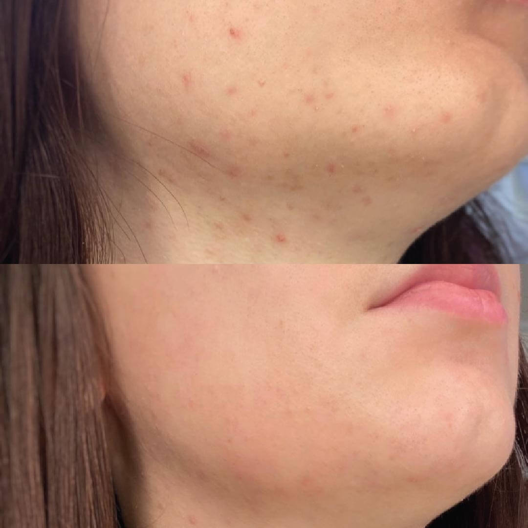 pelle acneica prima e dopo kubla