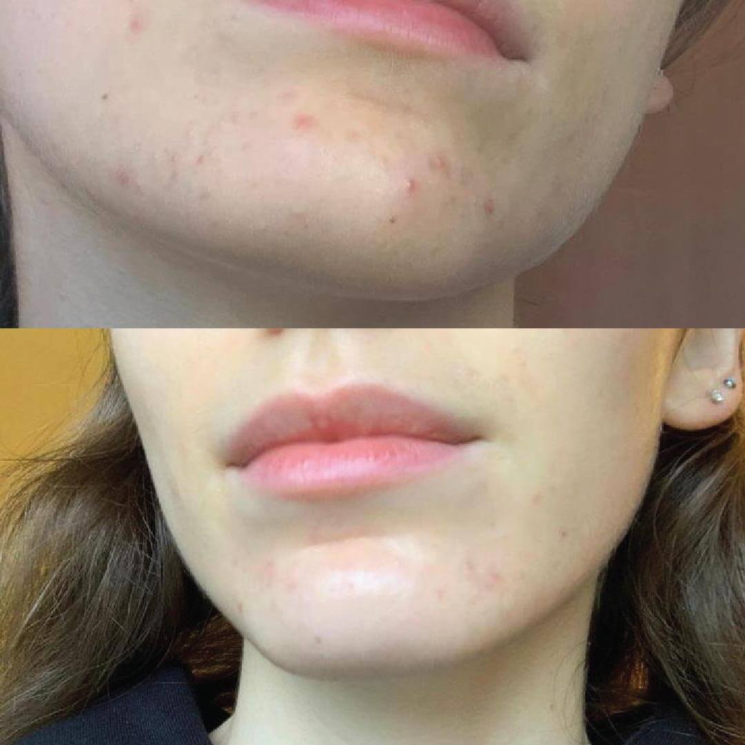 prima e dopo utilizzo prodotti Kubla