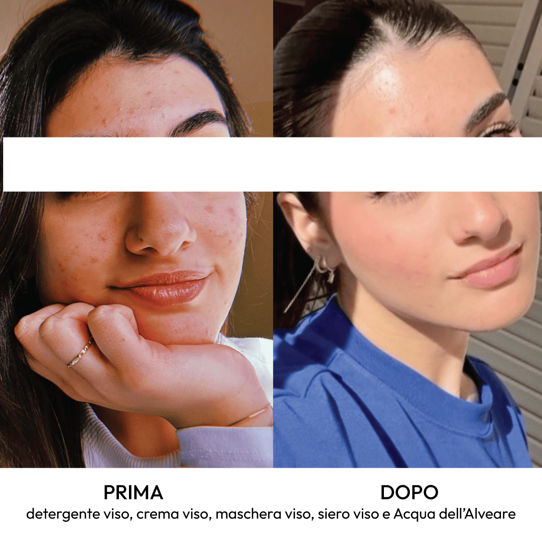 Kit Essenziale per acne, brufoli e macchie