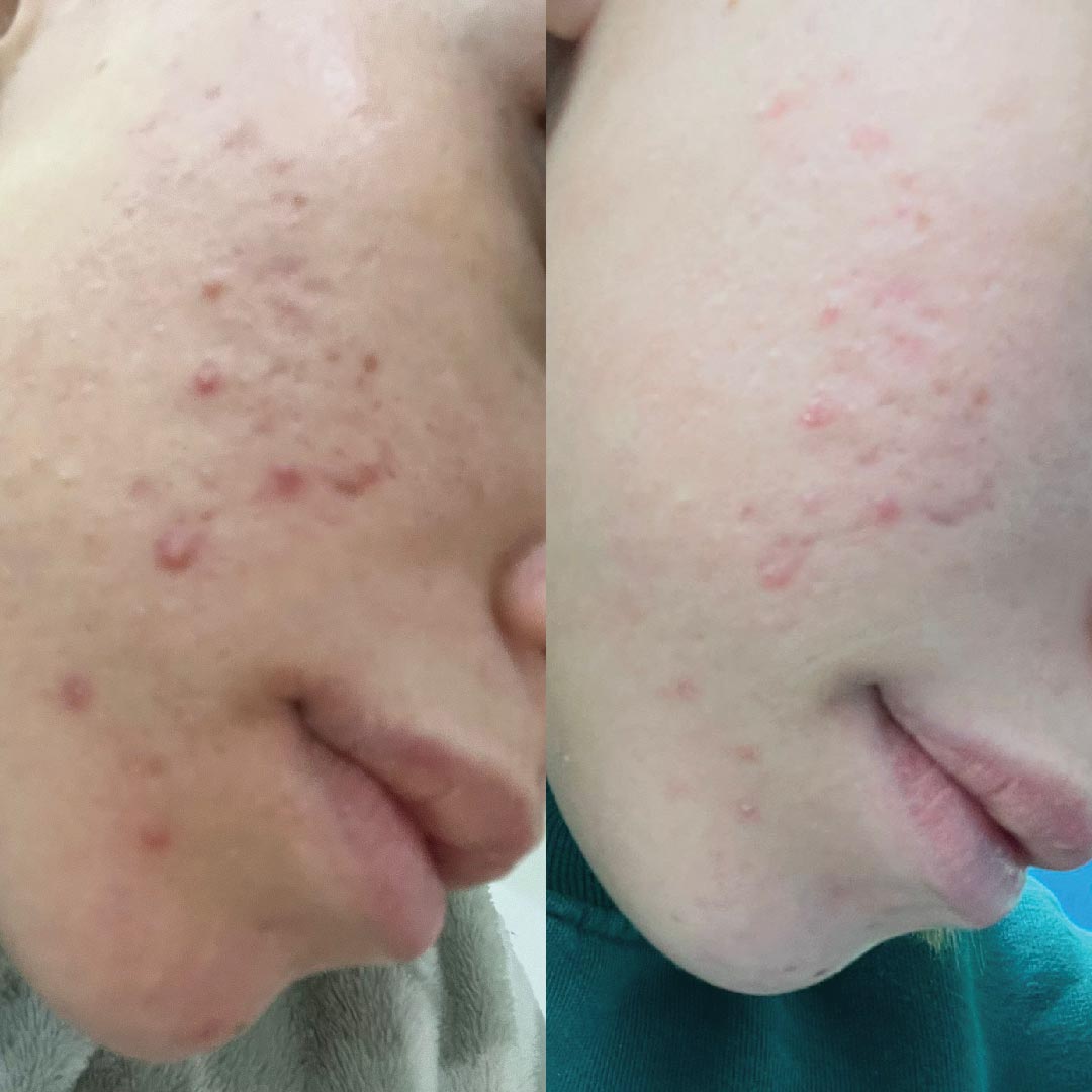 pelle acneica risultati applicazione kubla